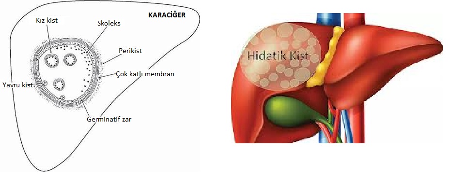 Kist Hidatik (Kistik Ekinokokkoz)