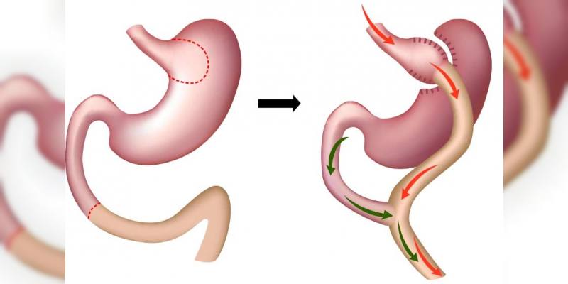 Gastrik Bypass